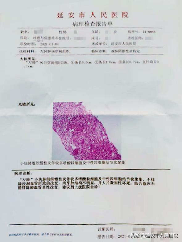 治疗肉芽肿性血管炎哪家医院好,嗜酸性肉芽肿性血管炎哪家医院好