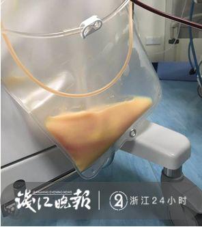 男子腹痛难忍满身大汗被抢救,男子腹痛住院抽出3000ml牛奶血