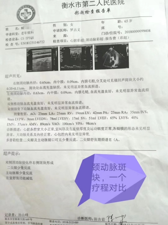 消斑块的秘方,祛血管斑块通络汤