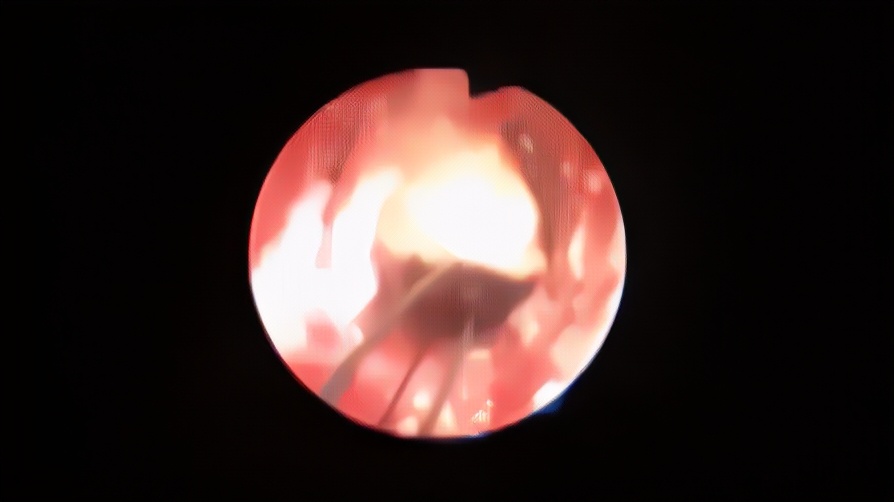 性的科学——“血精”有多可怕?从西门庆之死谈谈精囊炎