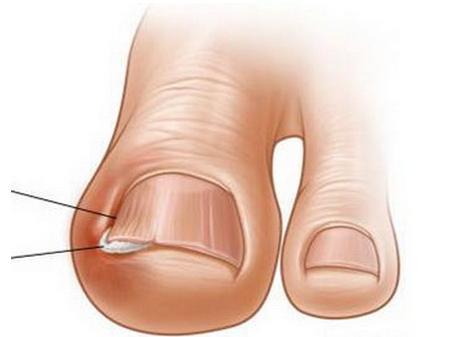 摆脱甲沟炎的痛苦之后的感想,甲沟炎的亲身经历