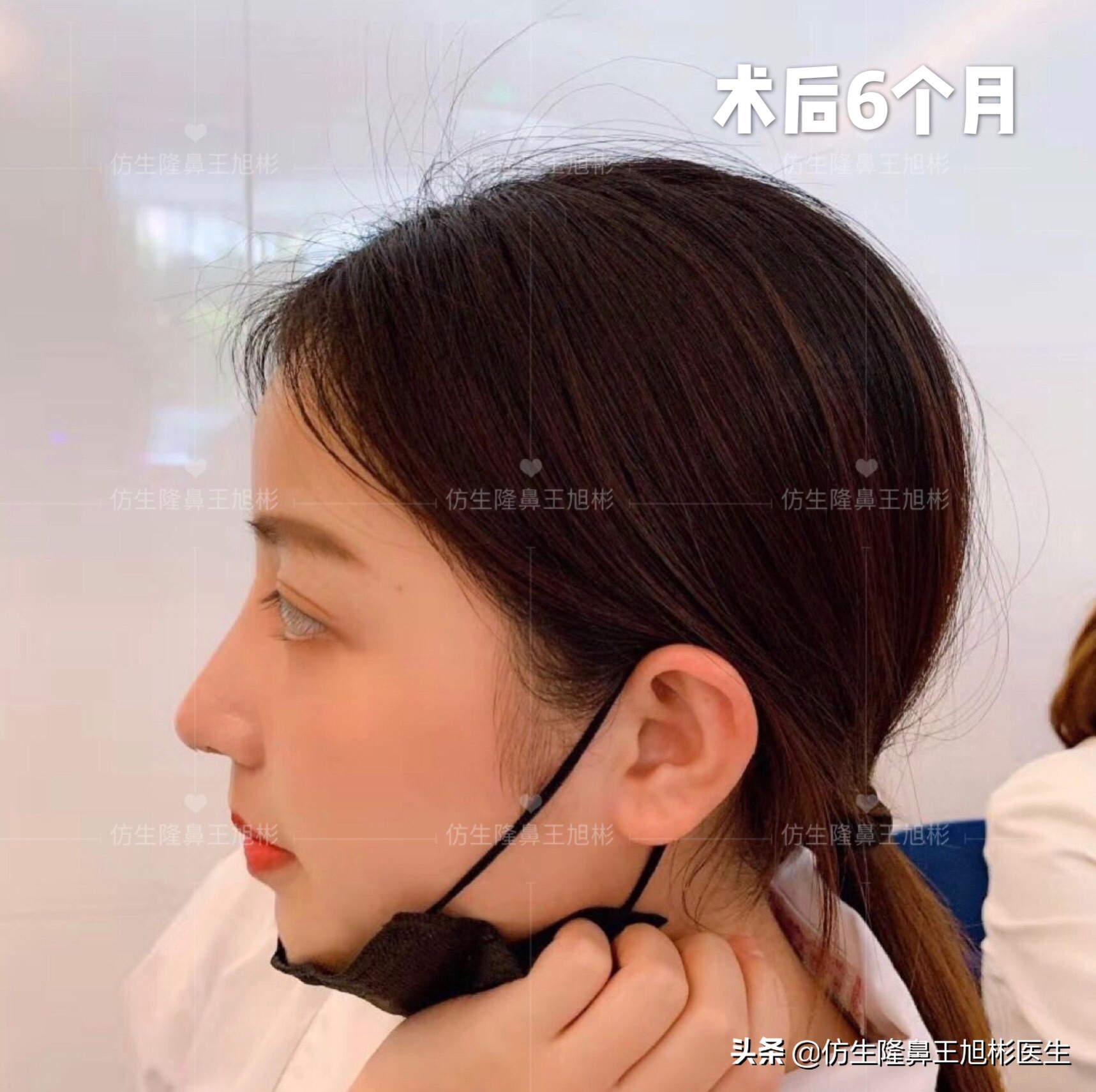 手术鼻头增厚能用什么方法弄,大鼻头高鼻梁缩小手术案例