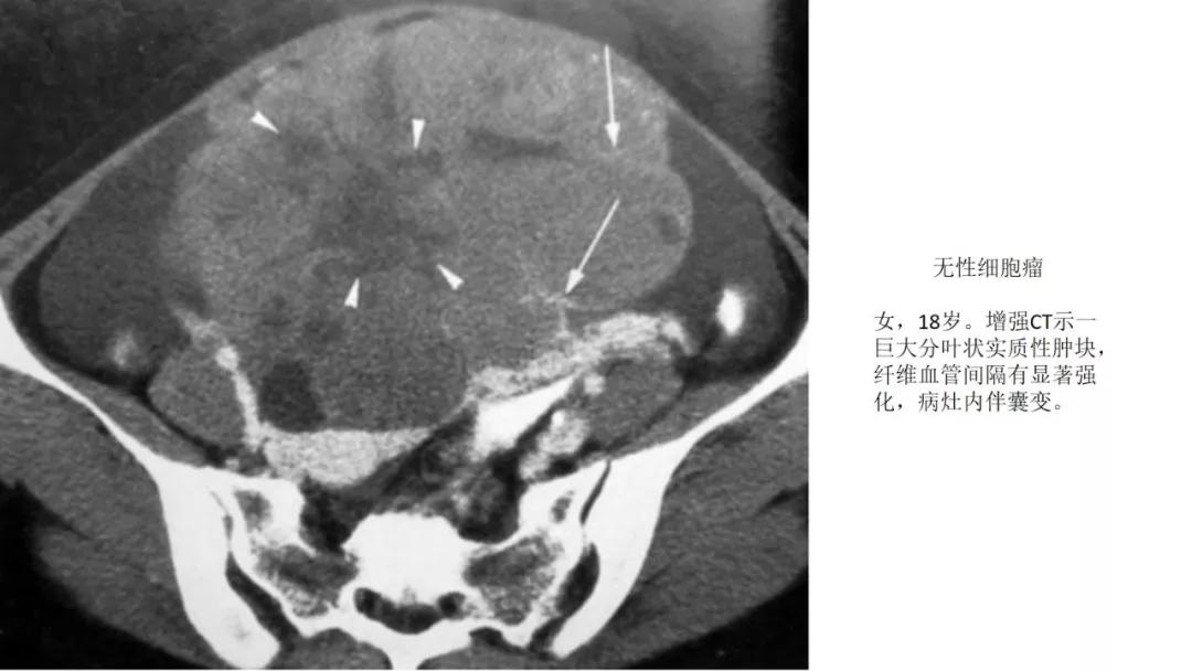 卵巢原发肿瘤的分析思路