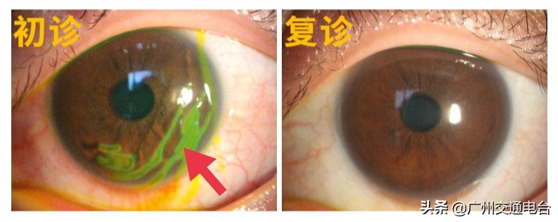 干眼症导致角膜损伤能恢复吗,笔盖坏了怎么补救