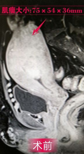 消除子宫肌瘤可用中药治疗吗,消除子宫肌瘤的特效药