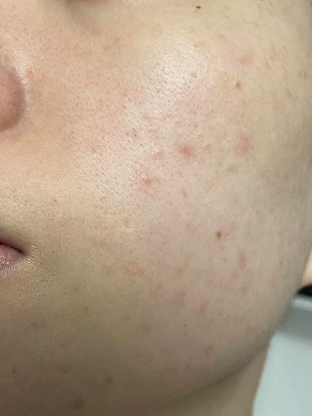 超皮秒避坑,超皮秒祛斑适合角质层薄的人