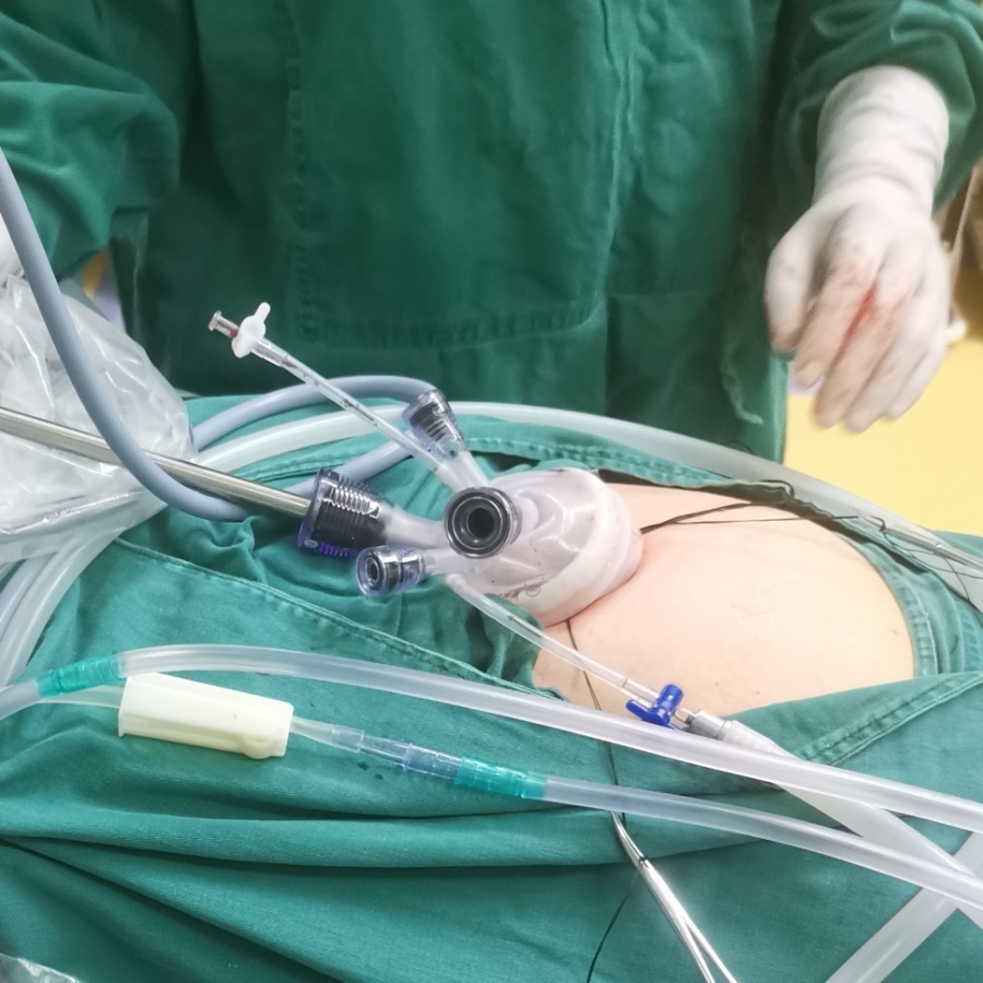 黔南州中医医院单孔腹腔镜为女性患者带来新福音