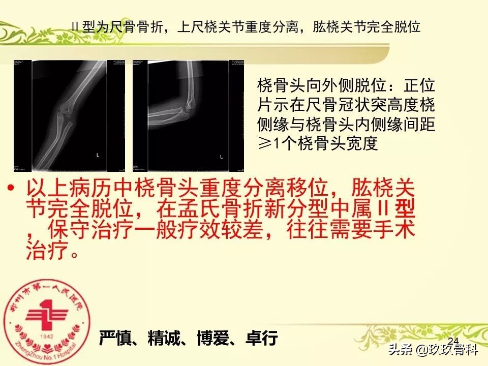 孟氏骨折功能训练多久能恢复正常,孟氏骨折中医能治吗