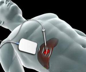 乙肝病人转氨酶高对肝有什么影响,慢性乙肝引起转氨酶高200