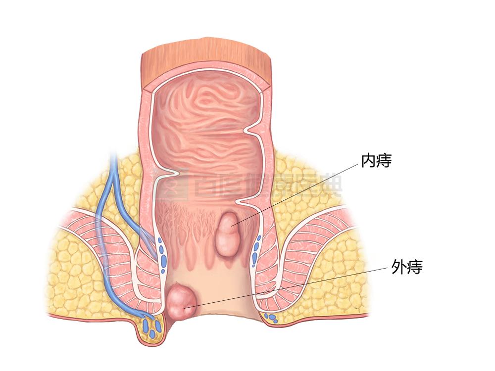 若你“大便出血”可能是患有以下疾病
