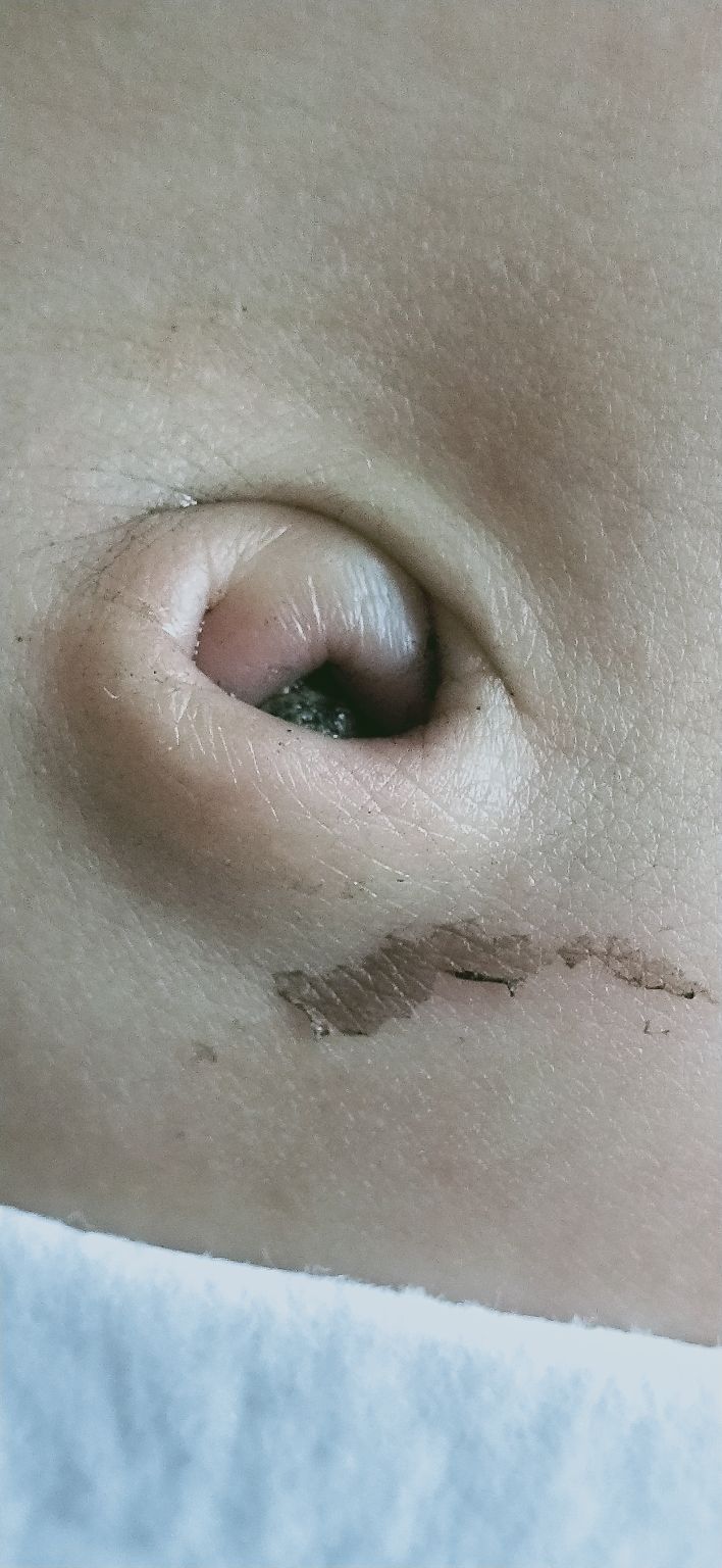 儿童脐茸怎么治,宝宝脐茸怎样处理