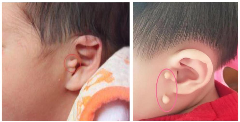 耳仓和拴马桩是什么,耳垂耳仓是富贵的征兆