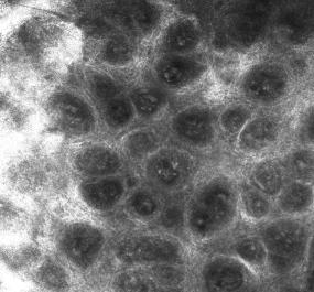 女儿得了银屑病怎么办,宝宝湿疹和银屑病区别