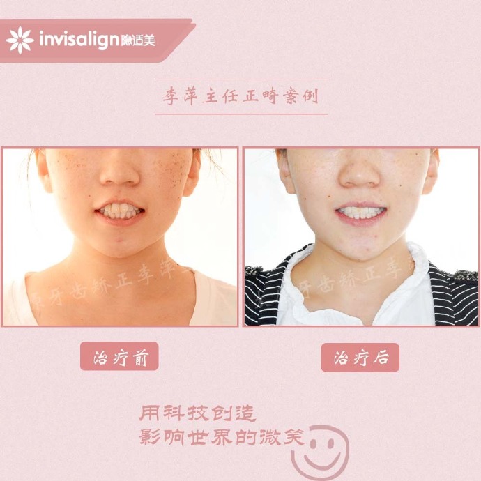 太原牙齿矫正拔牙拔六颗有危害吗,太原牙齿开合矫正