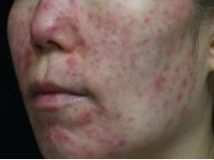 青春痘绝不仅仅影响颜值那么简单,青春痘可能只长一个吗