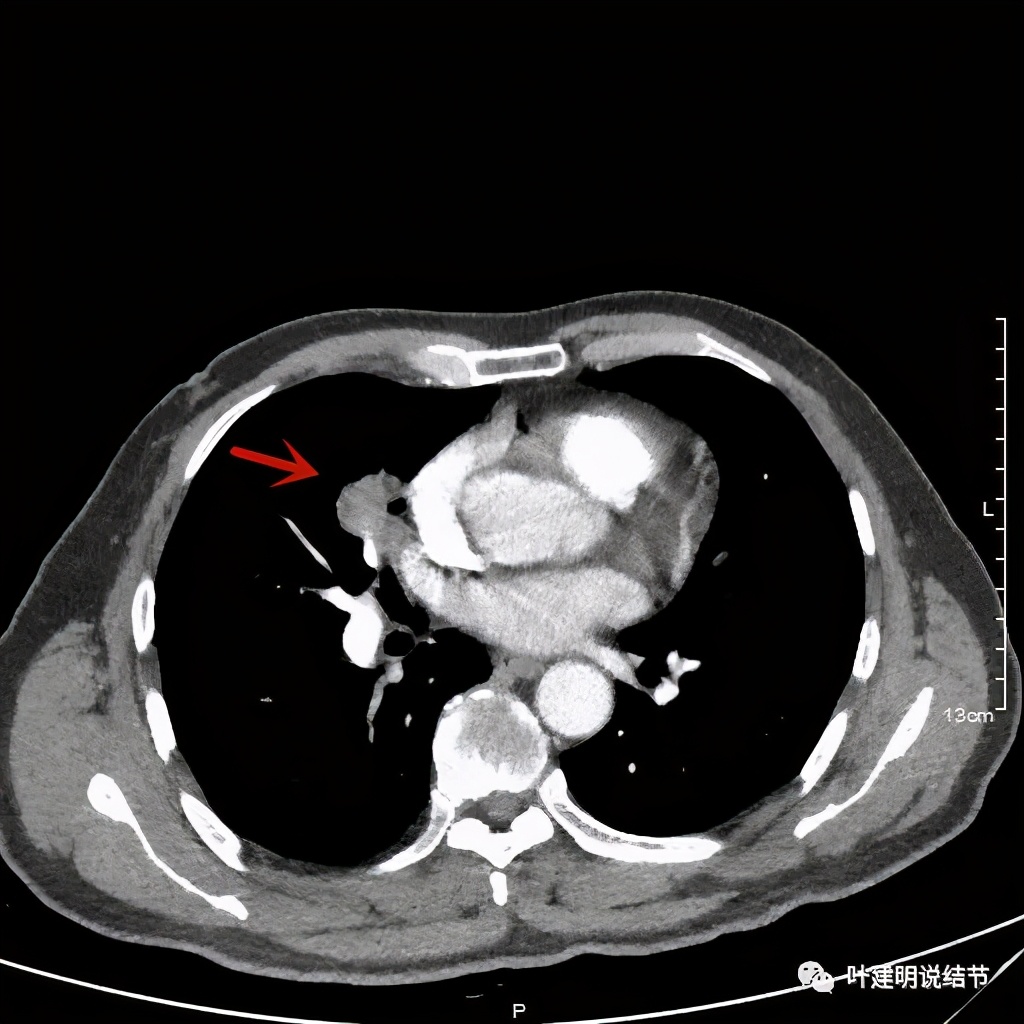 实性结节影要不要紧,实性结节穿刺活检为良性