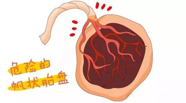 孕妇需要了解的疾病,孕期前置血管应注意什么