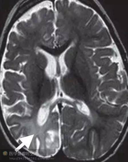 儿童癫痫CT表现,儿童各类癫痫脑电图特征