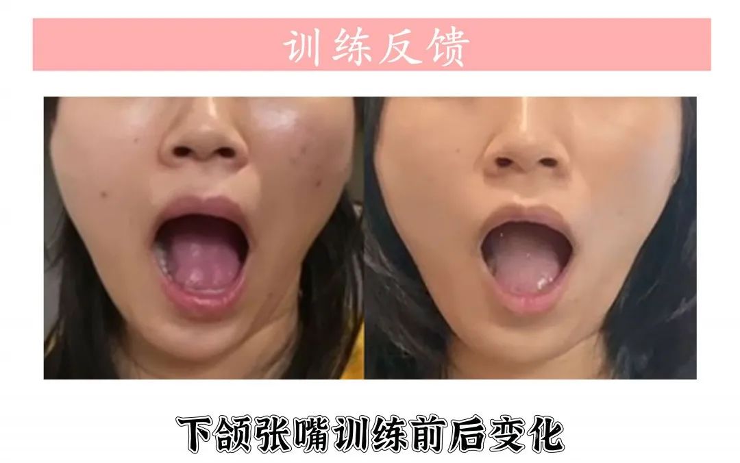 下颌角大小脸怎么改善,改善骨性大小脸歪脸最有效的方法