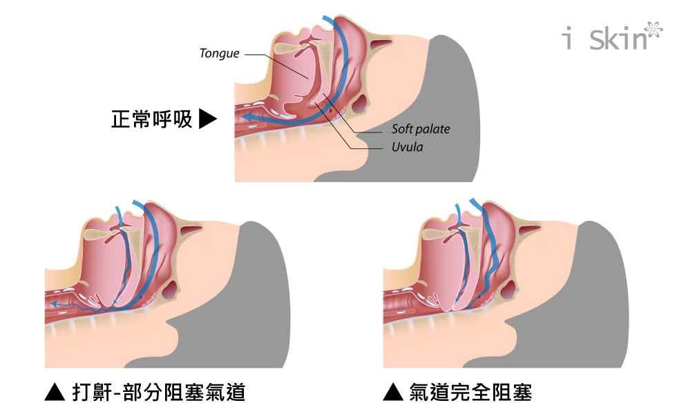 阻塞性睡眠呼吸暂停原理,什么叫阻塞性睡眠呼吸暂停综合征