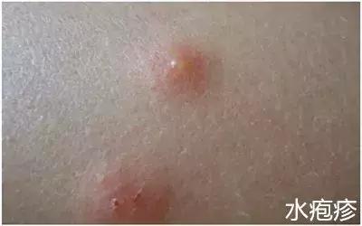 娃身上出了荨麻疹怎么办,娃儿有皮疹怎么止痒