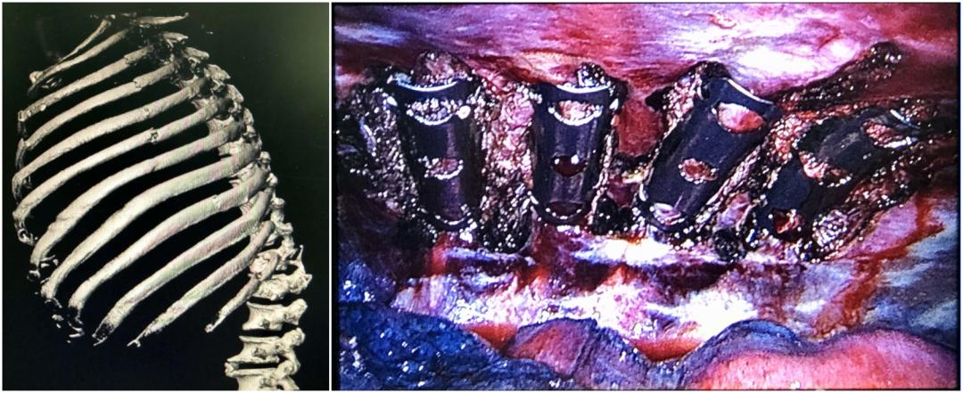 心胸血管外科有哪些手术,太原市中心医院心胸外科