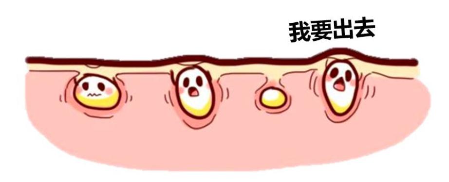 去黑头为什么黑头越来越多,长了黑头到底能不能挤