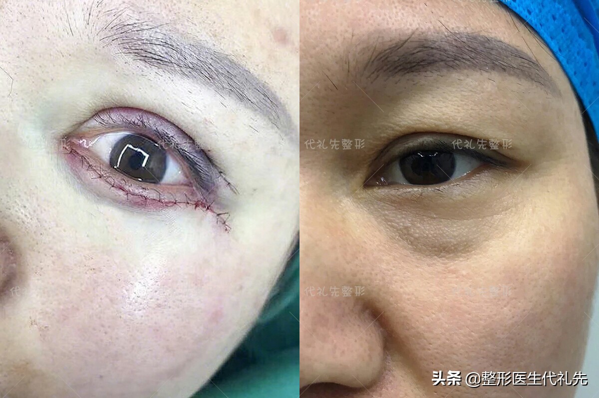 外切祛眼袋和内切祛眼袋哪个好些,超声祛眼袋好还是射频祛眼袋好呢