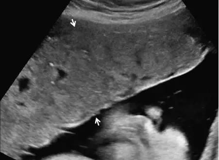 临床上最常见的异常胎盘,前置胎盘和低置胎盘超声