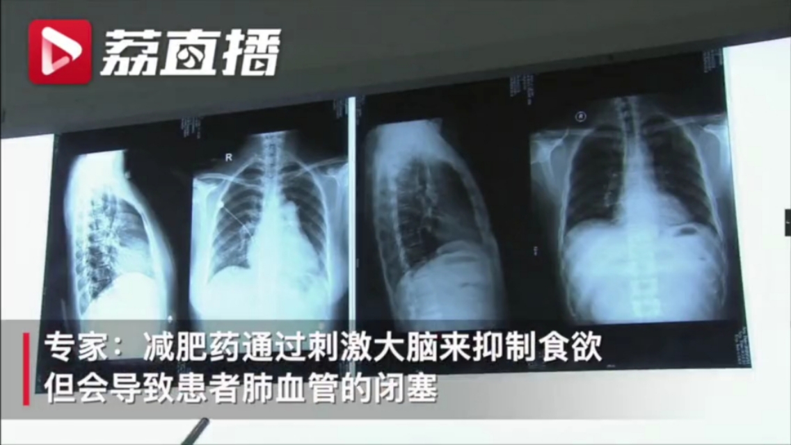 10年吃三十多种减肥药,十年吃了三十多种减肥药