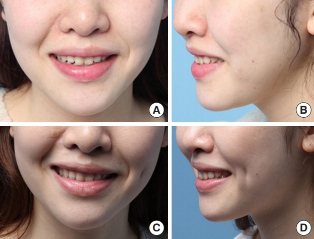 人造酒窝身体的缺陷,人造酒窝全过程