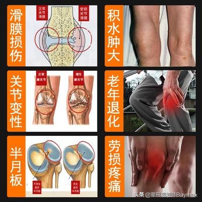 膝盖积水怎么办？不要只静养了，4个动作帮你有效缓解