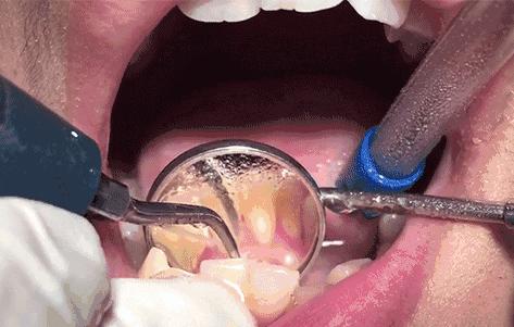 洗牙之后牙缝敏感,洗牙疼不疼