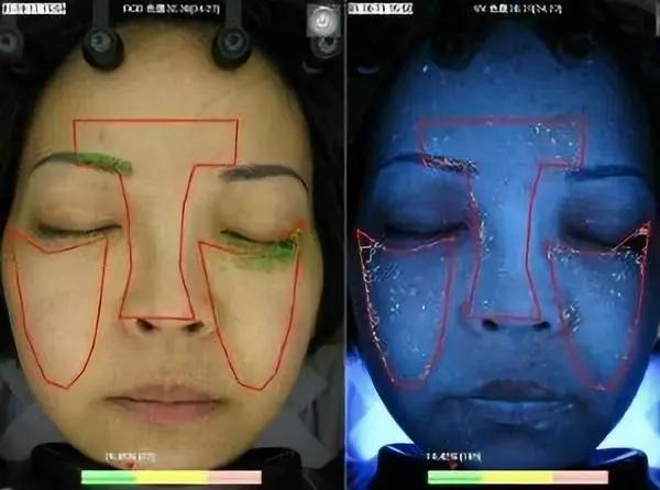 脂肪粒别用针挑教你一个土办法,脂肪粒怎么用针挑出来不疼