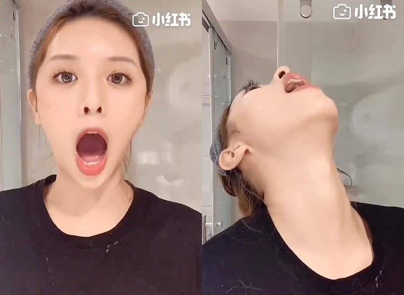 练精致下颚线,徐睿知脸部提升