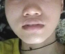 鼻翼缩小内缩和外缩的区别,鼻头缩小和鼻翼缩小是一个手术吗