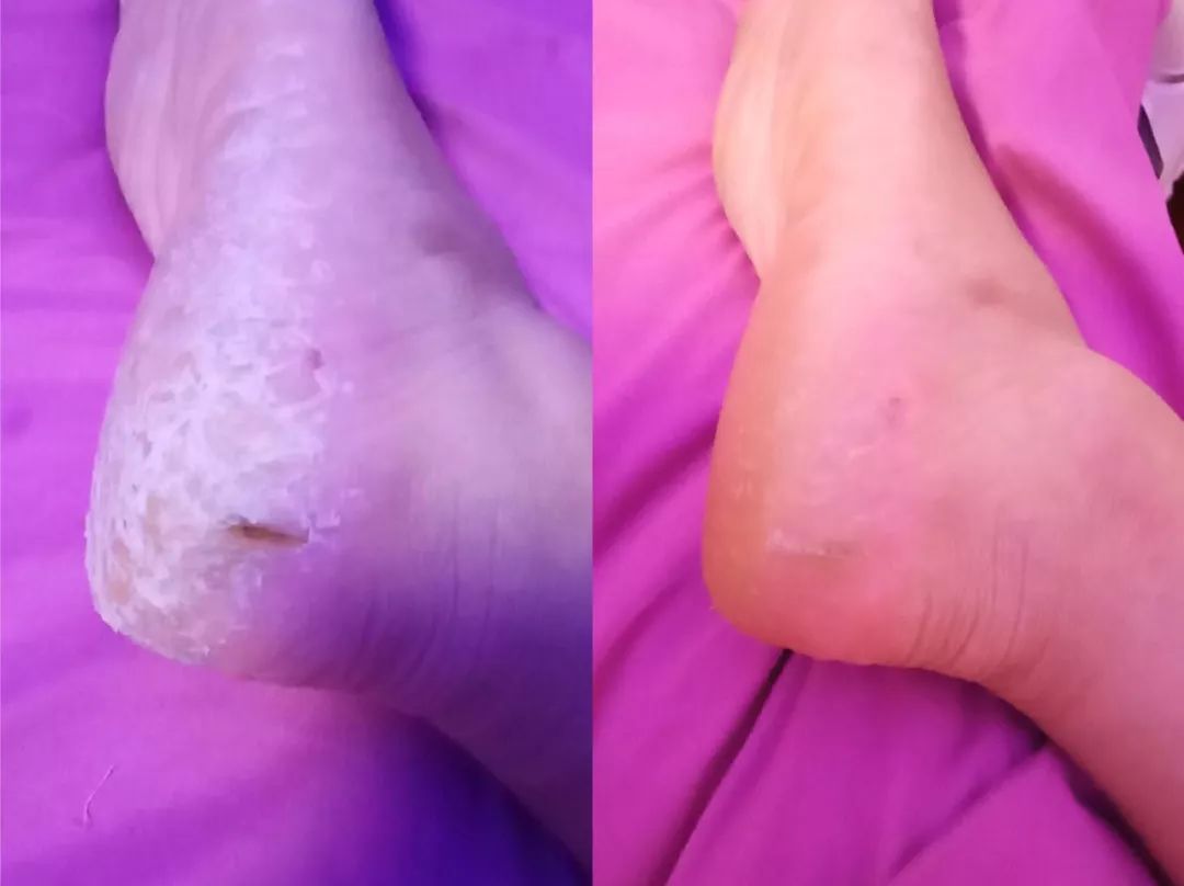 后脚跟干裂护足霜排行榜第一名,护脚霜脚后跟干裂修复霜国货