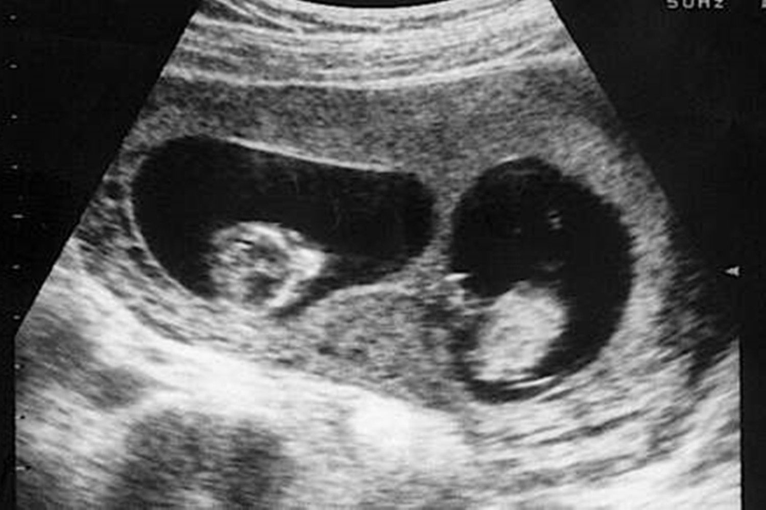 龙凤胎姐姐腹中被“吸收”，B超影像留弟弟腿上，网友：最美胎记