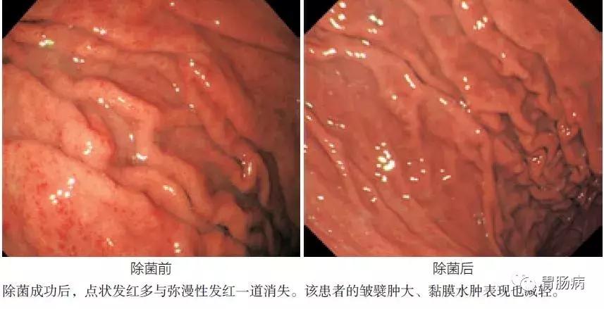 慢性浅表性非萎缩性胃炎伴糜烂,浅表性非萎缩胃炎吃什么药