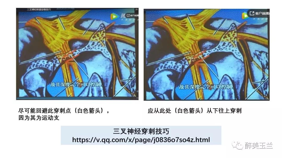 病例分享丨三叉神经节微球囊压迫术的麻醉管理