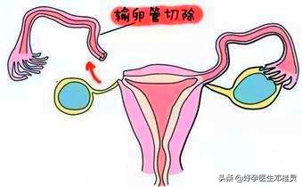 3次宫外孕保守治疗,宫外孕3次怎么办