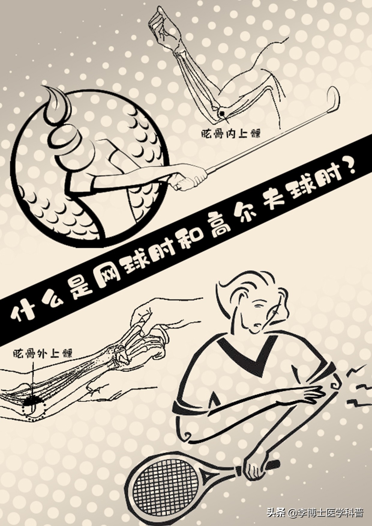 网球肘和高尔夫球肘会同时得吗,网球肘和高尔夫肘如何防治