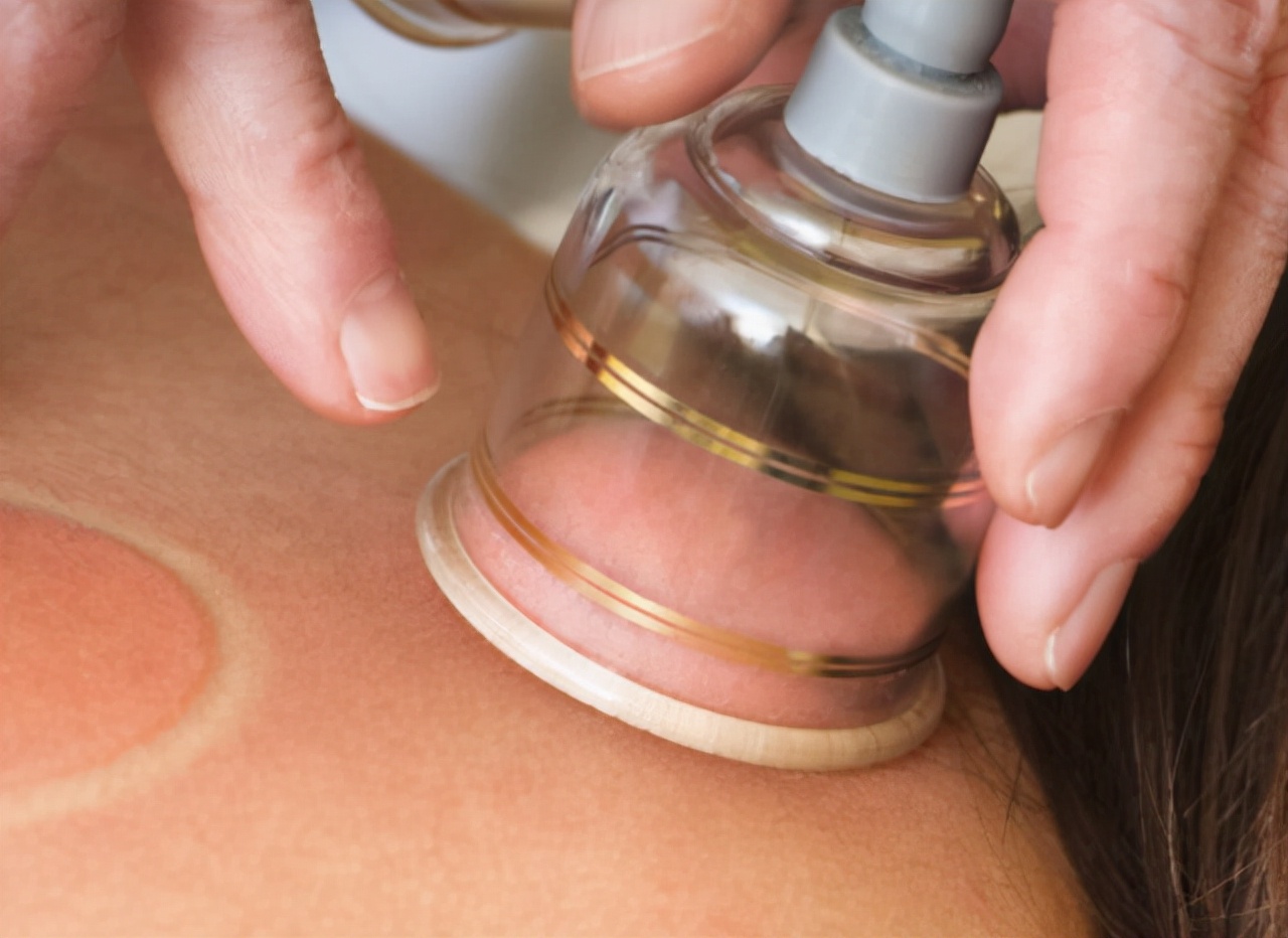 拔火罐时,后背吸出的瘀血是毒素吗?听听医生怎么说