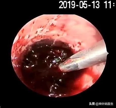 球囊扩张血肿怎么办,经皮穿刺脑血管腔内球囊成形术