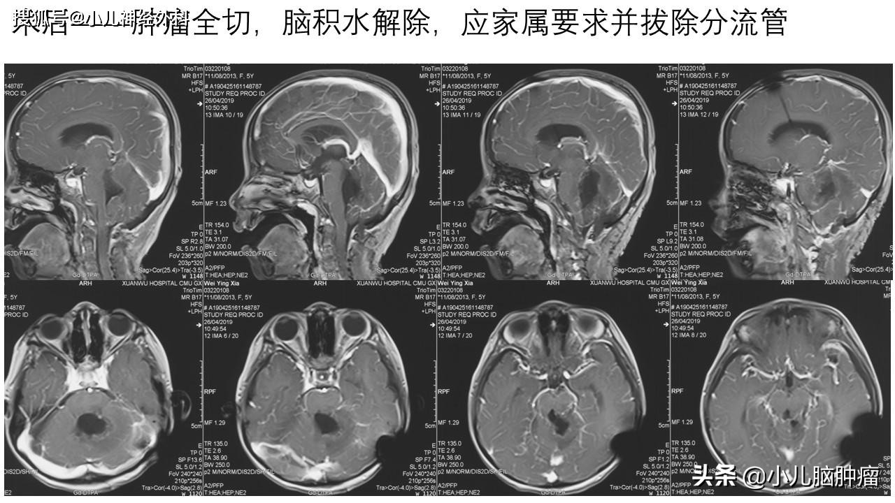 脑肿瘤后做脑积水引流会扩散吗,脑积水分流管是在颅内还是颅外