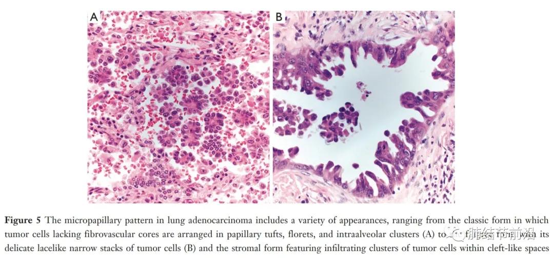 早期肺腺癌分哪几种,微浸润肺腺癌病理为什么没有分型