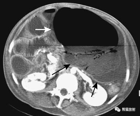 腹部影像图片大全,乙状直肠疼痛位置图片