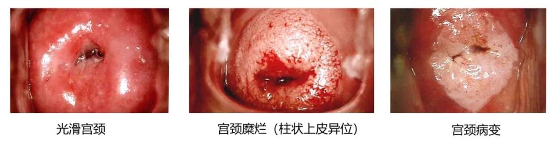 宫颈糜烂能治好吗能痊愈吗,宫颈糜烂能治好吗需要多久