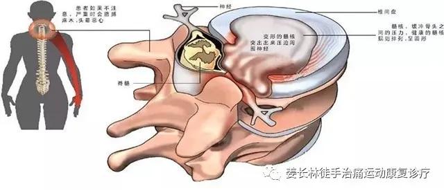 尺神经卡压自我恢复锻炼,枕大神经卡压自我恢复锻炼