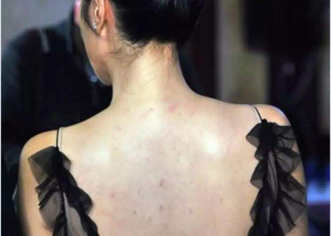 后背长了很多小米粒,后背长满小米粒的原因